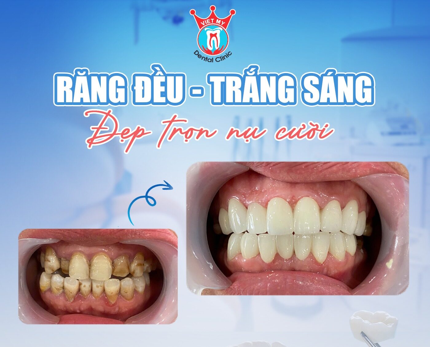 Feedback răng sứ thẩm mỹ