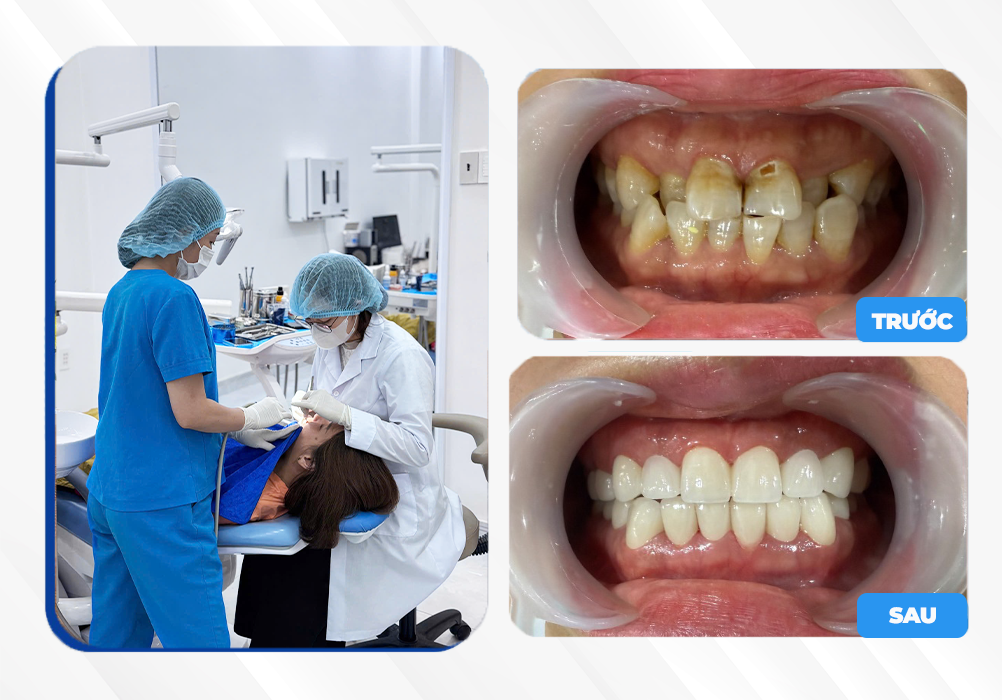 Răng sứ thẩm mỹ Gia Lai