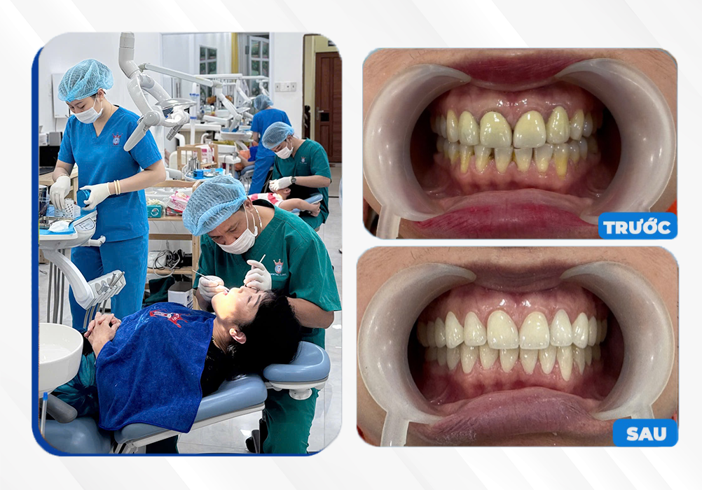 Răng sứ thẩm mỹ