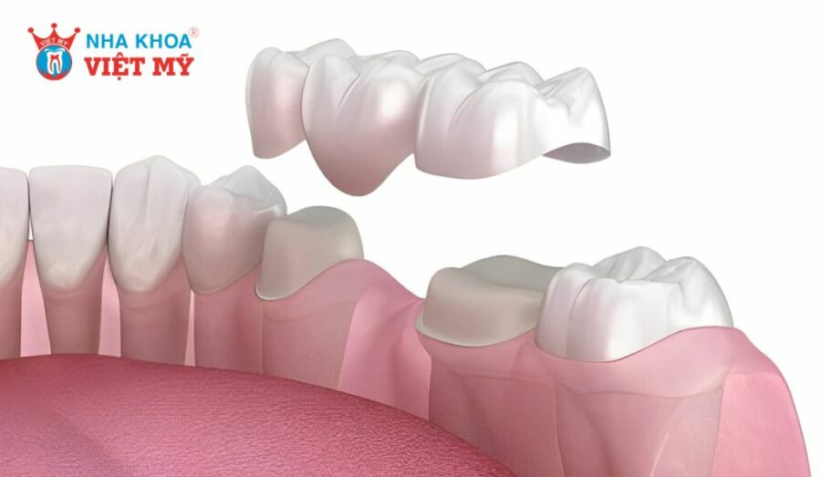 Yếu tố ảnh hưởng đến chi phí chụp răng hàm