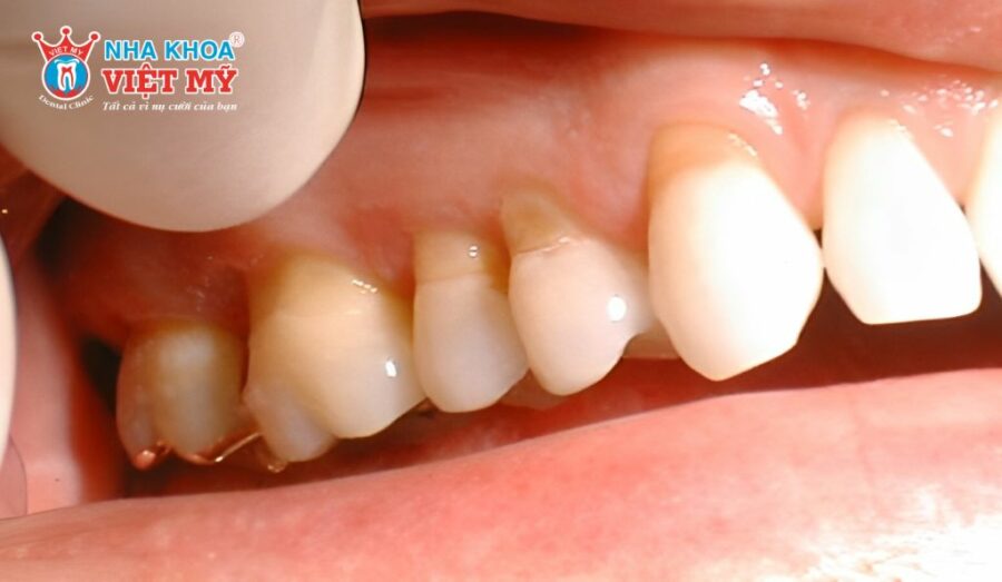 Mòn cổ răng là trường hợp phổ biến cần được chụp răng hàm