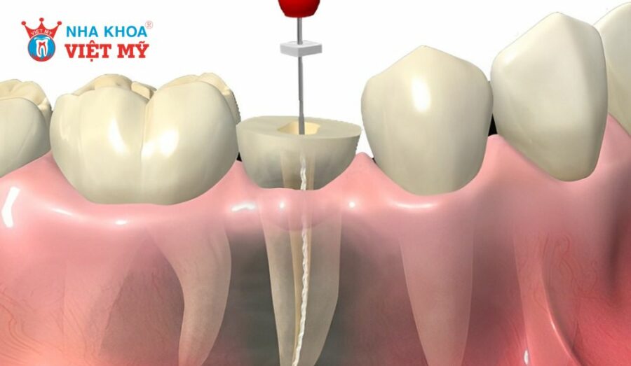 Những trường hợp chụp răng hàm cần lấy tủy