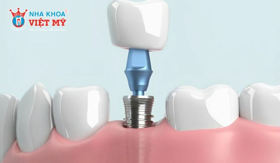 Mức giá giao động trên thị trường hiện nay khi chụp răng hàm