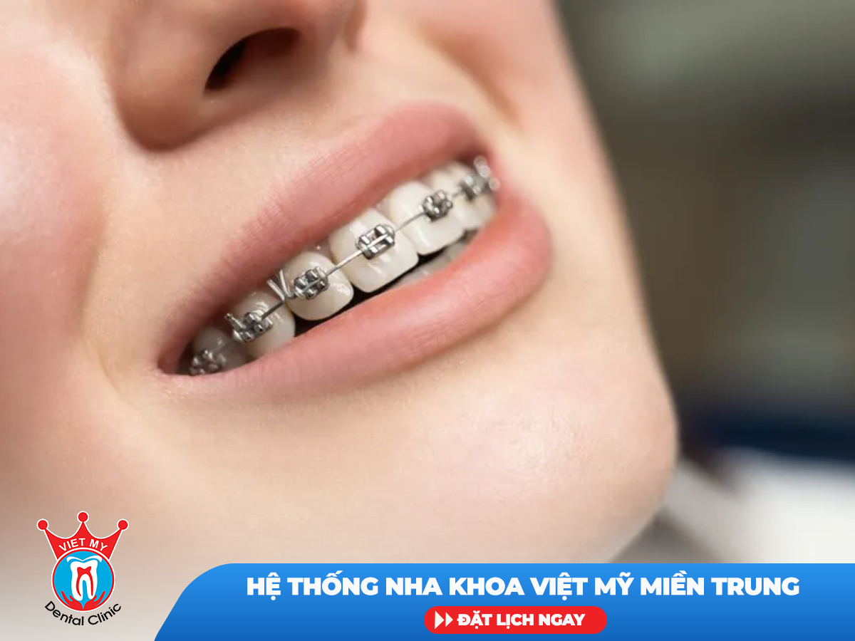 Niềng răng Gia Lai