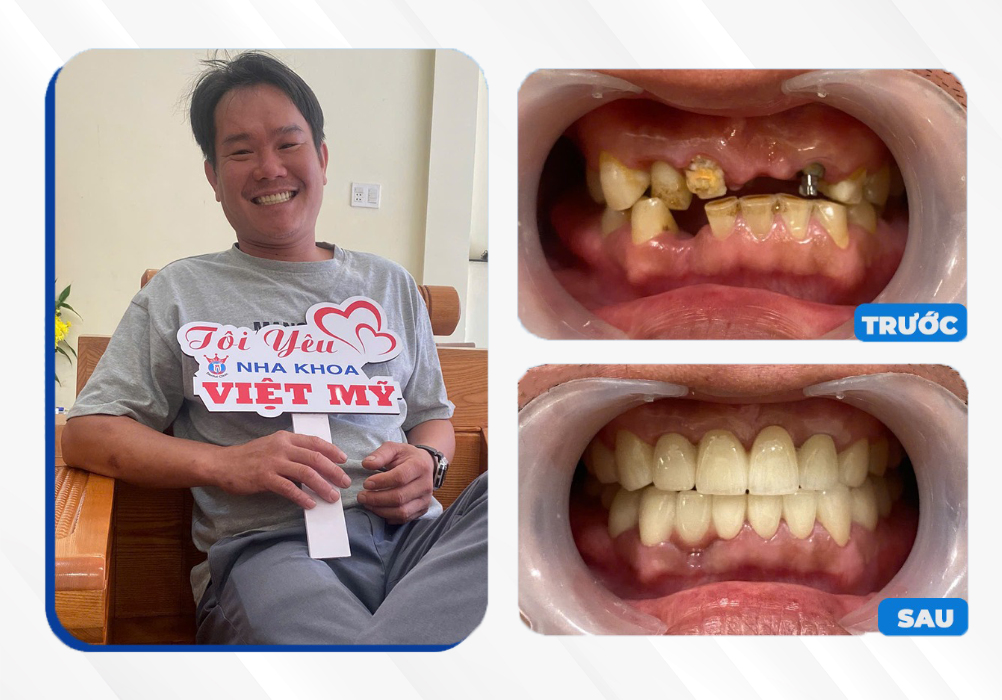 Răng sứ thẩm mỹ Gia Lai