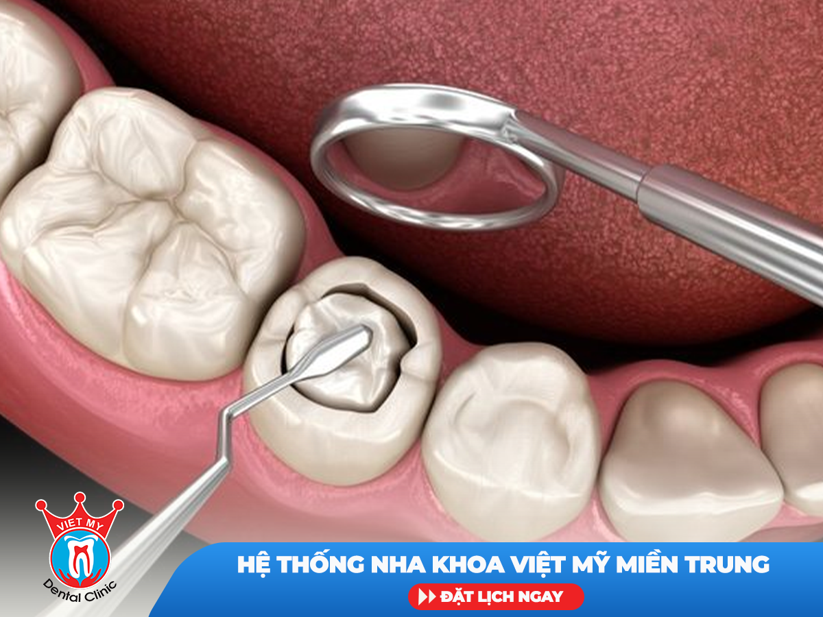 Trám răng -Nhổ răng