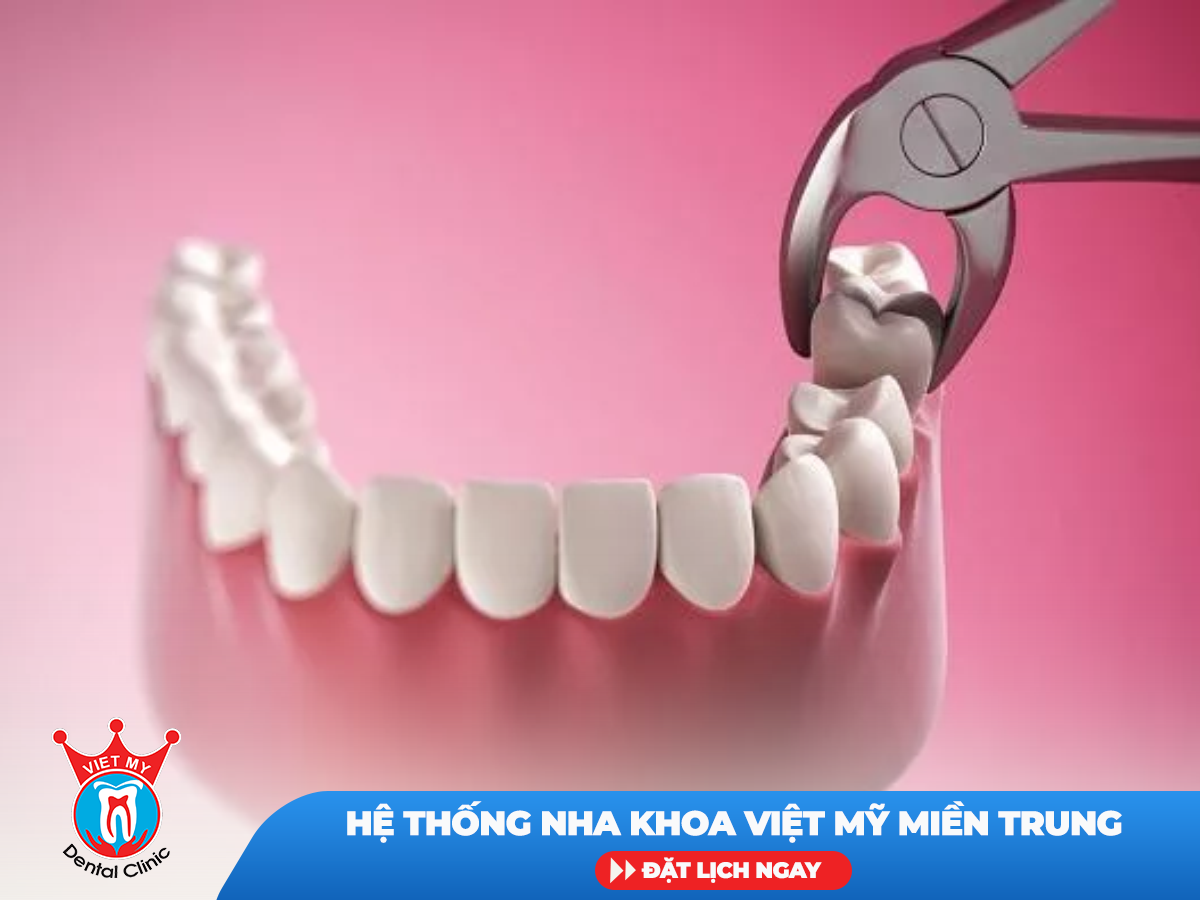 Trám răng - Nhổ răng