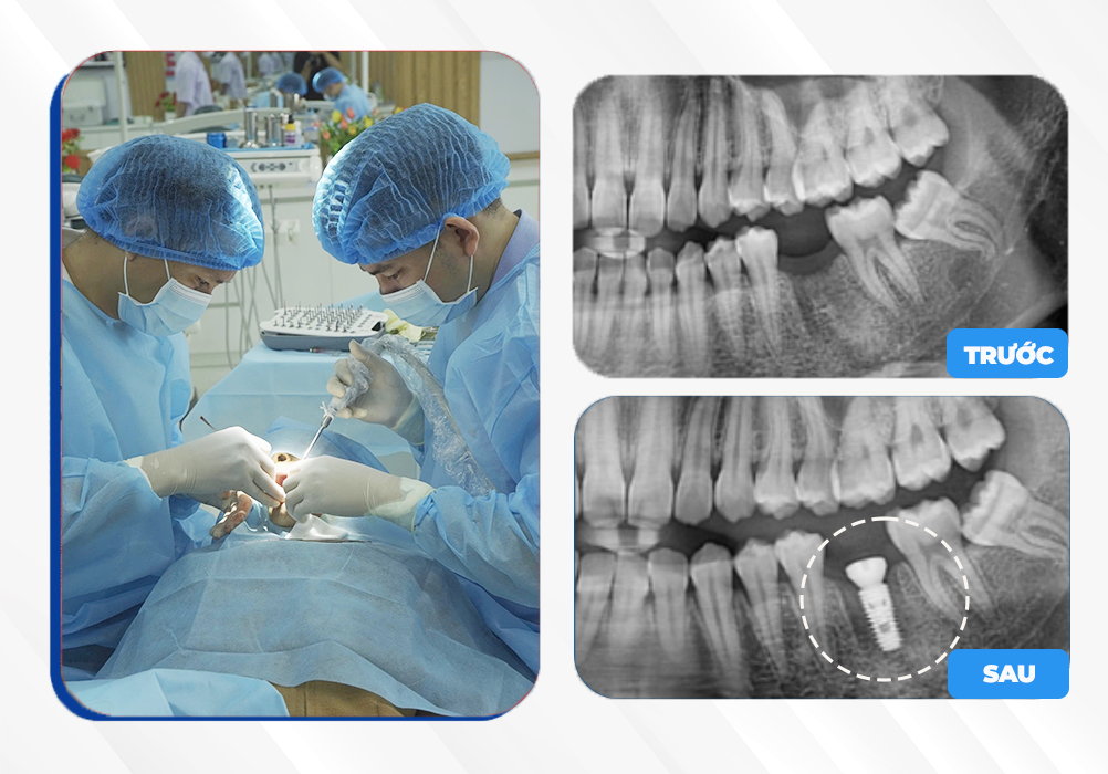 Trồng răng Implant Gia Lai