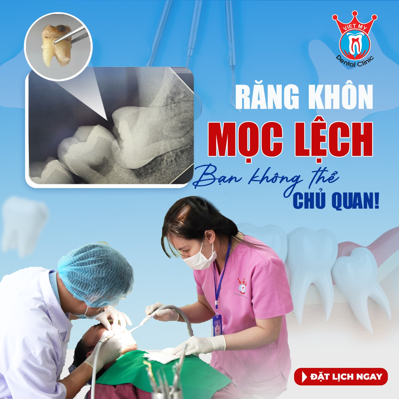 Nhổ răng khôn tại Gia Lai