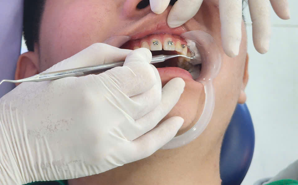 Niềng Răng tại Gia Lai