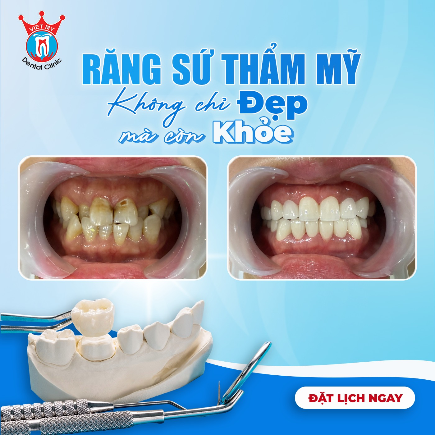 Răng sứ thẩm mỹ tại Gia Lai
