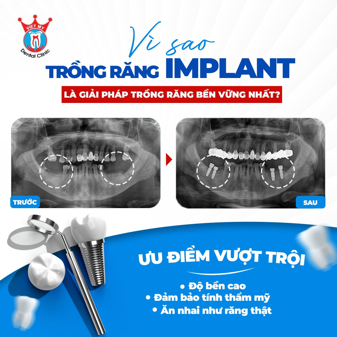 Trồng răng Implant tại Gia Lai