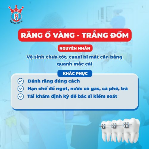 lưu ý khi niềng răng