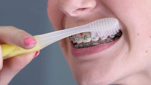 gắn mắc cài
