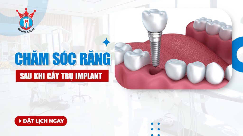 chăm sóc sau khi cấy trụ Implant