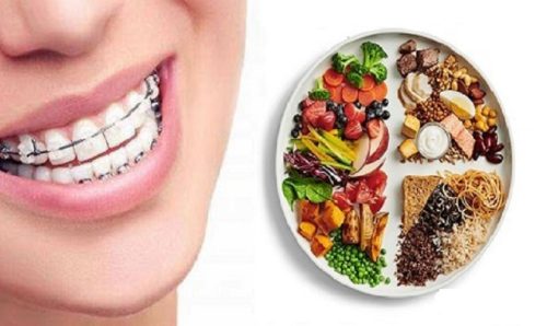 sai lầm khi niềng răng