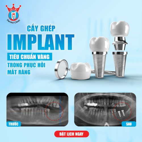 trồng răng implant