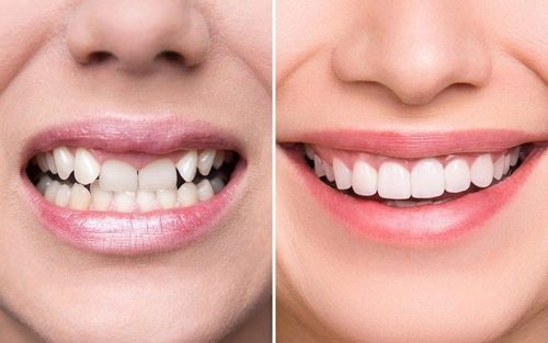 lợi ích của niềng răng